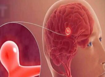 Ανεύρυσμα: Σημάδια και συμπτώματα που δεν πρέπει να αγνοήσετε