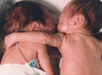 ΑΓΡΙΝΙΟ: ΣΤΟ ΝΟΣΟΚΟΜΕΙΟ ΔΙΔΥΜΑ ΜΩΡΑΚΙΑ 17 ΗΜΕΡΩΝ – ΑΠΟ «ΠΑΝΩ» ΤΟΥΣ ΟΙ ΓΙΑΤΡΟΙ