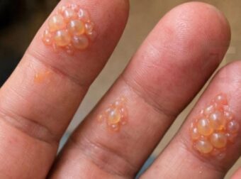 Τα δάχτυλα του συζύγου είναι καλυμμένα με αυτές τις μικροσκοπικές φουσκάλες νερού. Δεν μπορεί καν να πληκτρολογήσει για τη δουλειά