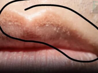 Γιατί μπορεί να δείτε ασυνήθιστα λευκά οζίδια στα χείλη ή στα γεννnτικά σας όpγανα