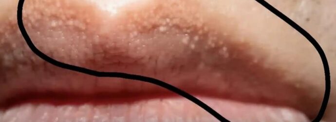 Γιατί μπορεί να δείτε ασυνήθιστα λευκά οζίδια στα χείλη ή στα γεννnτικά σας όpγανα