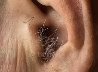 Το γνωρίζατε; Αν φυτρώνουν τρίχες στα αυτιά σας, αυτό συμβαίνει επειδή το σώμα σας