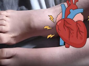 Ένα μήνα πριν από το έμφραγμα, τα πόδια σας θα σας προειδοποιήσουν με αυτά τα 6 σημάδια