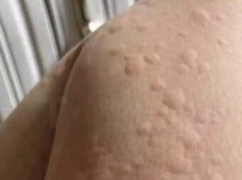 Γιατί εμφανίζονται πομφοί στο δέρμα; Αυτοί είναι οι απρόσμενοι παράγοντες που ίσως δεν γνωρίζετε