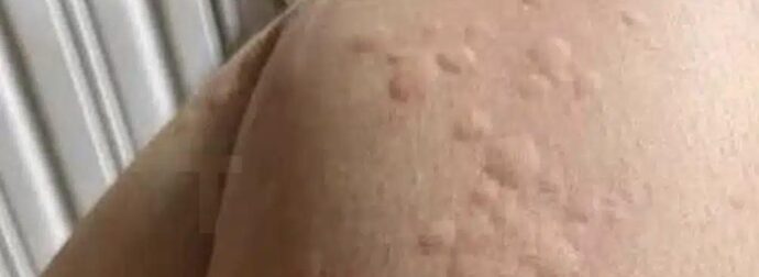 Γιατί εμφανίζονται πομφοί στο δέρμα; Αυτοί είναι οι απρόσμενοι παράγοντες που ίσως δεν γνωρίζετε