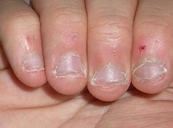 Οι άνθρωποι που τρώνε τα νύχια τους έχουν αυτό το χαρακτηριστικό στην προσωπικότητα τους