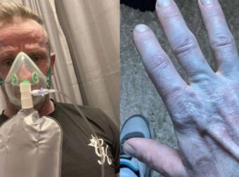 Μεγάλη Βρετανία: Άνδρας ξύπνησε και ήταν όλος μπλε: Όταν πήγε στο νοσοκομείο οι γιατροί έκλαψαν από τα γέλια