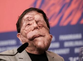 Χαμός στα Όσκαρ: Πασίγνωστος ηθοποιός εμφανίστηκε με αυτό το πρόσωπο και… πάγωσαν όλοι – Η σπάνια αρρώστια που τον «χτύπησε»