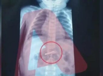 Στο νοσοκομείο Παίδων 3χρονο αγόρι – Τι σoκaριστικό κατάπιε