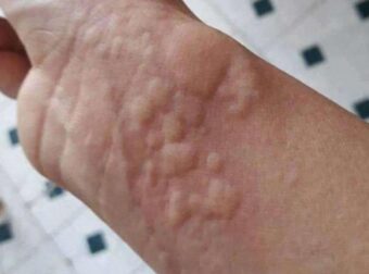 Τι σημαίνουν τα σημάδια στο δέρμα;