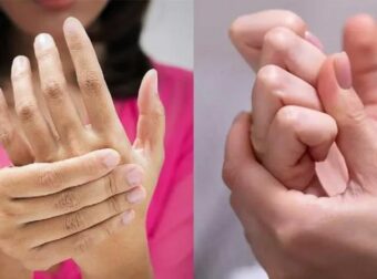 Αν τα δάχτυλα χεριών ή ποδιών γίνουν έτσı, πρέπεı να κάνετε εξετάσεις στους πνεύμονες