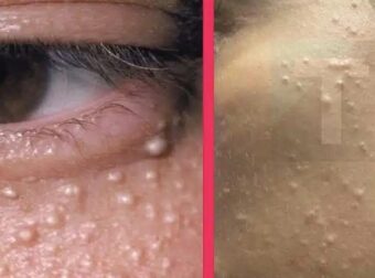 Γιατί εμφανίζονται μικρά λευκά σπυράκια στο πρόσωπο