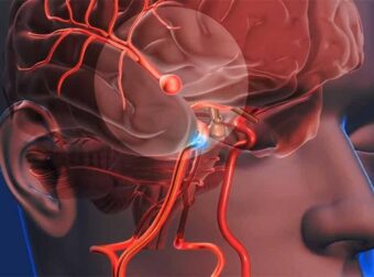Ανεύρυσμα: Σημάδια και συμπτώματα που δεν πρέπει να αγνοήσετε
