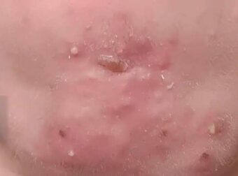 Έβγαινα με μια γυναίκα που γνώρισα στο σουπερμάρκετ και αφού τελικά πήγα μαζί της ξύπνησα με αυτά στο πρόσωπό μου