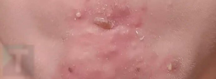 Έβγαινα με μια γυναίκα που γνώρισα στο σουπερμάρκετ και αφού τελικά πήγα μαζί της ξύπνησα με αυτά στο πρόσωπό μου