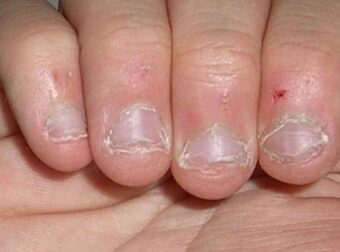 Οι άνθρωποι που τρώνε τα νύχια τους έχουν αυτό το χαρακτηριστικό στην προσωπικότητα τους