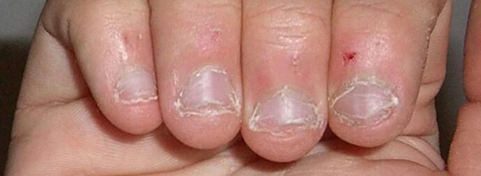 Οι άνθρωποι που τρώνε τα νύχια τους έχουν αυτό το χαρακτηριστικό στην προσωπικότητα τους