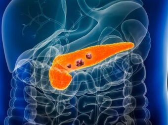 Σημάδια καρκίνου του παγκρέατος που δεν πρέπει ποτέ να αγνοήσετε