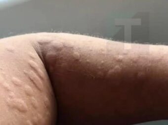 Τι είναι, πώς εμφανίζεται και πότε χρειάζεται ιατρική επίβλεψη