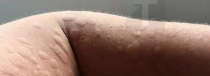 Τι είναι, πώς εμφανίζεται και πότε χρειάζεται ιατρική επίβλεψη