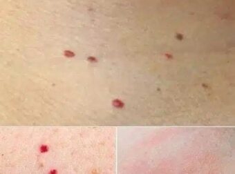 Κόκκινες κουκκίδες στο δέρμα: Τι μπορεί να σημαίνουν και πότε πρέπει να απευθυνθείτε σε γιατρό